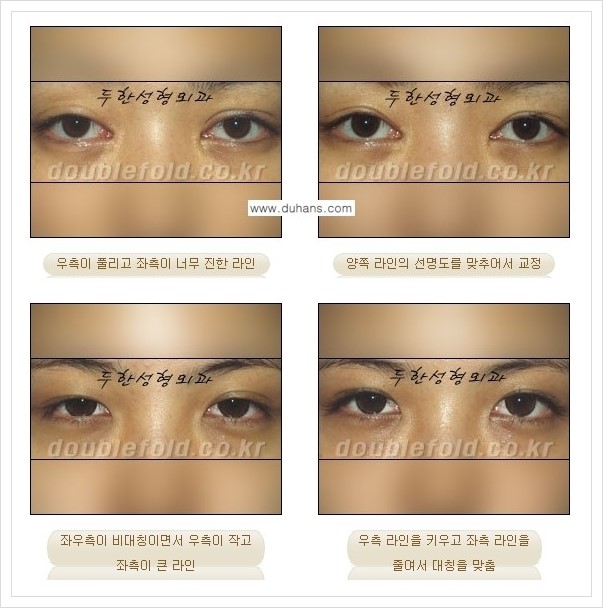 [두한성형외과 경쟁력 쌍꺼풀 재수술] - [짝짝이(비대칭) 쌍꺼풀 라인 교정하는 방법 안내 2.] 관련 이미지 5