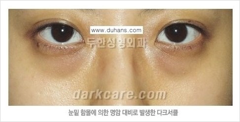 [두한성형외과 경쟁력 눈밑성형] - [눈밑 다크써클 원인과 눈밑 다크써클 치료 방법 안내] 관련 이미지 4
