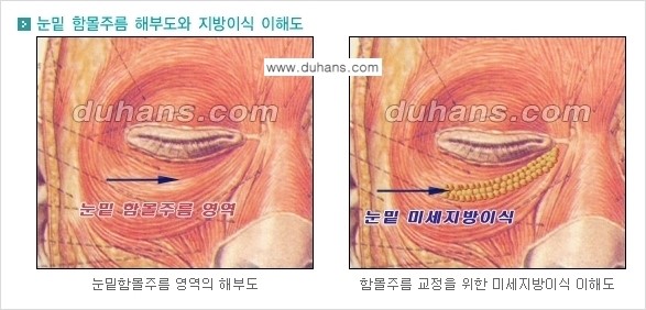[두한성형외과 경쟁력 미세지방이식] - [다크써클 & 눈밑주름 미세지방이식 4.] 관련 이미지 2