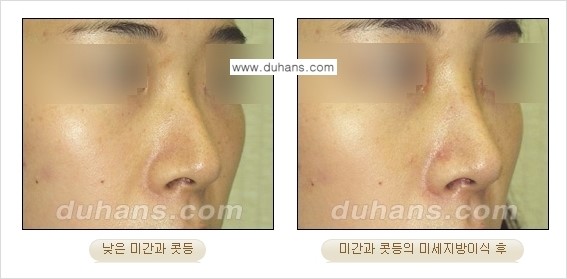 [두한성형외과 경쟁력 미세지방이식] - [코 지방이식 2.] 관련 이미지 6