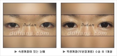 Best Place for Double Eyelid Revision Surgery, Duhan Plastic Surgery - Partial Incision Eye Revision Surgery image 23