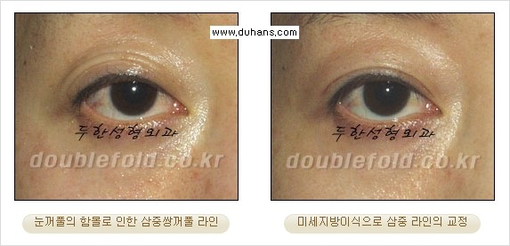 [두한성형외과 경쟁력 눈성형] - [삼중(세겹) 쌍꺼풀 라인의 교정] 관련 이미지 19