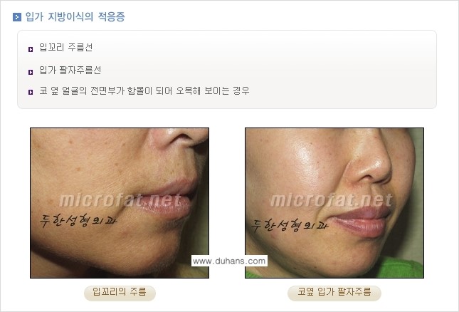 [두한성형외과의 경쟁력 있는 지방이식] - [입가주름, 팔자주름 미세지방이식 1.] 관련 이미지 1