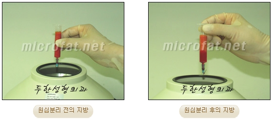 [Duhan Plastic Surgery Lip Surgery] - [Lip Correction Fat Grafting] image 5