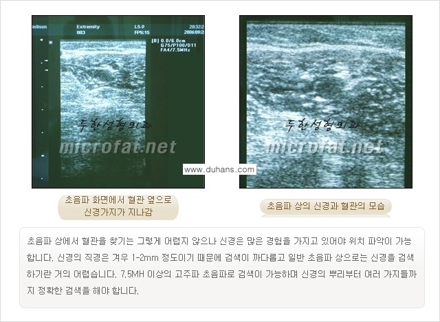 [두한성형외과 경쟁력 멀티종아리성형] - [초음파 유도 비절개 선택적 신경차단술의 효과] 관련 이미지 14