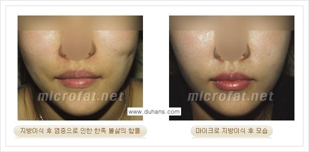 ​[두한성형외과 경쟁력 미세지방이식] - [타 병원에서 지방이식 후 발생한 굴곡현상 교정 방법 - 마이크로 지방이식] 관련 이미지 6