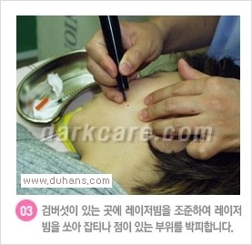 [두한성형외과 경쟁력 눈밑성형] - [다크써클 + 검버섯 레이저 콤비 프로그램 안내] 관련 이미지 5