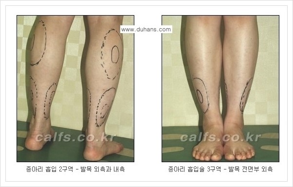 [두한성형외과 경쟁력 멀티종아리성형] - [나에게 맞는 종아리성형 방법의 종류 안내 2.] 관련 이미지 11
