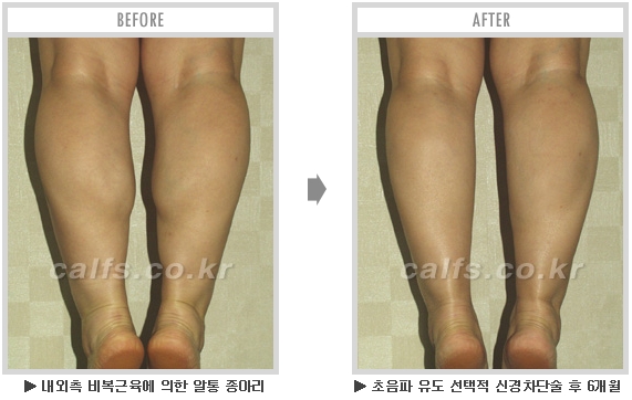 [종아리성형 두한성형외과] - [종아리수술에 대한 자주하는 질문과 답변 모음] 관련 이미지 62