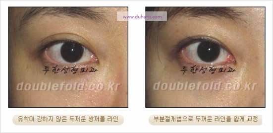 [두한성형외과 경쟁력 눈성형] - [쌍꺼풀 재수술에 대한 최선의 대안 제시] 관련 이미지 27
