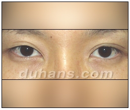 Candidates for Double Eyelid Revision Surgery: Unattractive Double Eyelids, Beautiful Double Eyelids image 22