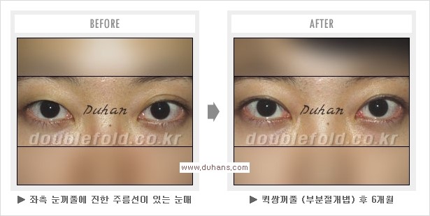 ​[두한성형외과 경쟁력 눈성형] - [퀵쌍꺼풀(부분절개법) 수술 관련 자주하는 질문과 답변] 관련 이미지 8