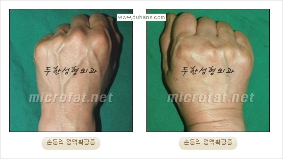 [두한성형외과 경쟁력 정맥류 치료] - [손, 손등, 손목혈관확장증, 팔혈관확장증에 질문과 답변] 관련 이미지 1