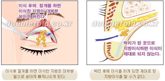 [Duhan Plastic Surgery Eye Surgery] - [Revision Surgery for a Dropped Double Eyelid] image 42