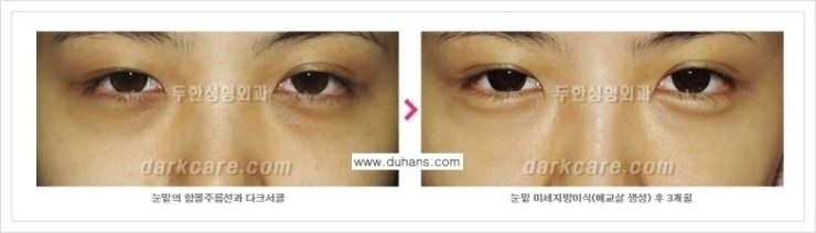 [두한성형외과 경쟁력 눈밑성형] - [눈밑 애교살 - 이상적인 눈밑 미세지방이식 방법] 관련 이미지 9