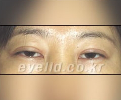 Duhan Plastic Surgery Eye Surgery - Are You a Candidate for Double Eyelid Revision Surgery?! image 7