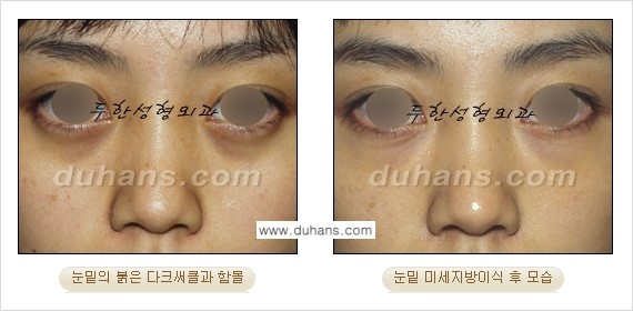[두한성형외과 FOCUS 눈밑성형] - [다크써클의 치료방법 -  콜펫(Col-fat) 눈밑 미세지방이식 ⑤] 관련 이미지 10
