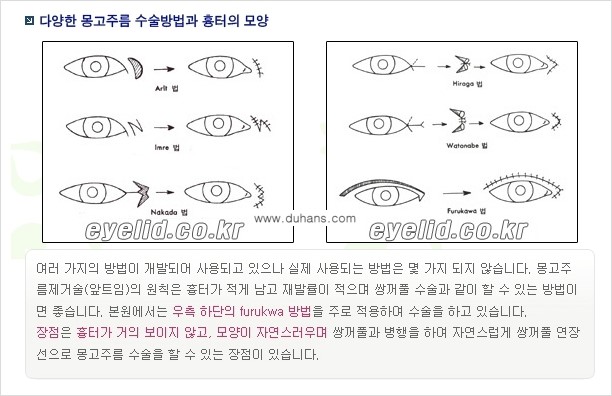 [두한성형외과 눈성형 FOCUS] - [몽고주름 제거(앞트임 제거) 수술 ②] 관련 이미지 10