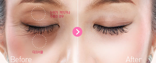[눈밑수술 두한성형외과] - [다크서클 콤비프로그램] 관련 이미지 40