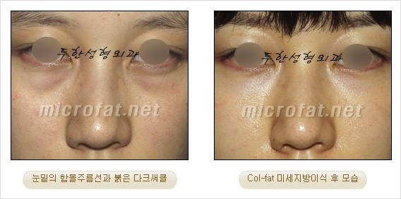 ​[두한성형외과 경쟁력 눈밑성형 리더] - [눈밑 다크써클의 증상, 원인, 종류, 치료방법 안내] 관련 이미지 41