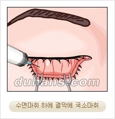 ⁠⁠[두한성형외과 경쟁력 안검성형] - [젊은 눈매를 위한 윗눈꺼풀 지방제거, 눈밑 지방제거] 관련 이미지 14