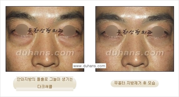 [두한성형외과 젊은 눈매 안검성형] - [눈밑 지방제거의 수술 전후 안내 ②] 관련 이미지 14