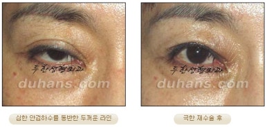 [Special Double Eyelid Revision Surgery at Duhan Plastic Surgery] - [Restorative Surgery for Damaged Double Eyelid Eye Shape] image 5