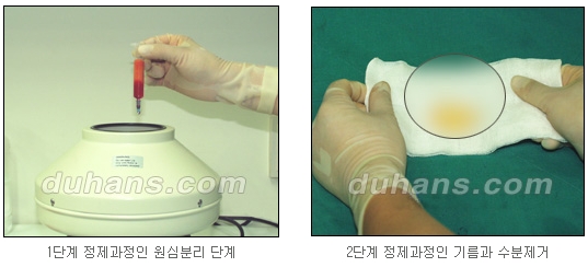 [두한성형외과 얼굴자가지방이식] - [지방이식 과정] 관련 이미지 4