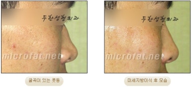 [Duhan Plastic Surgery Facial Fat Grafting] - [Fat Grafting Rhinoplasty] image 12