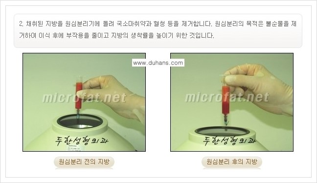 [두한성형외과의 경쟁력 미세지방이식] - [무턱교정, 턱 미세지방이식 안내 1.] 관련 이미지 9