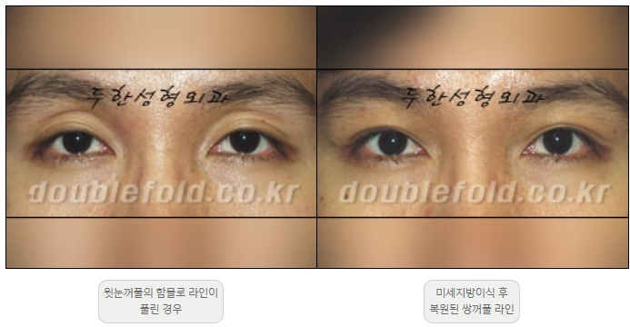[두한성형외과 쌍커풀재수술] - [풀린 쌍커풀라인 교정] 관련 이미지 15