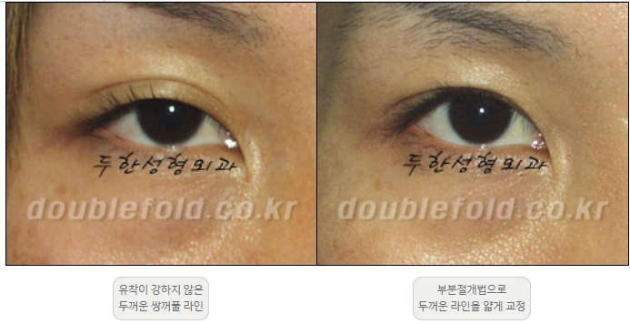 [Duhan Plastic Surgery Double Eyelid Revision] - [Thick Double Eyelid Line] image 28