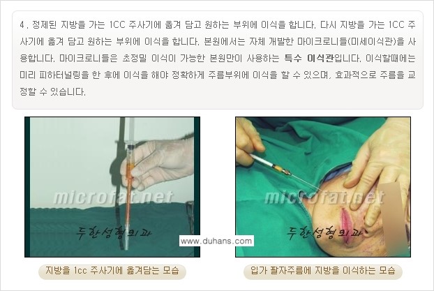 [두한성형외과의 경쟁력 있는 지방이식] - [입가주름, 팔자주름 미세지방이식 1.] 관련 이미지 5
