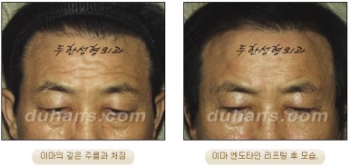 Duhan Plastic Surgery Forehead Surgery - Forehead Lifting Endotine Lifting image 13