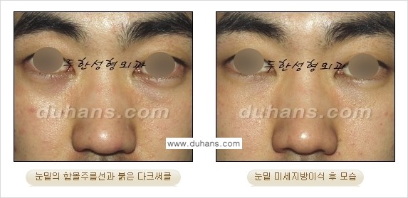 [두한성형외과 상큼하고 환한 눈매완성] - [눈밑 미세지방이식 ①] 관련 이미지 7