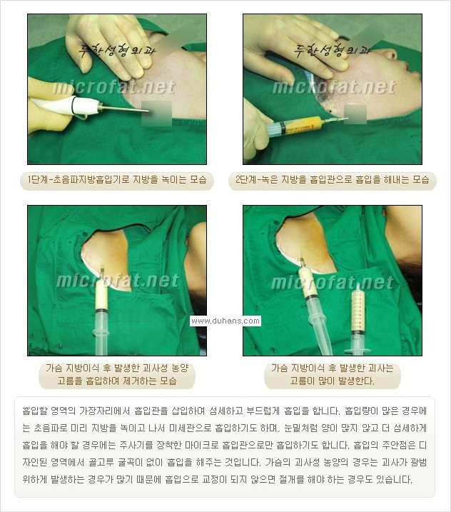 [두한성형외과 경쟁력 미세지방이식] - [타 병원에서 볼살 지방이식 이후 부작용 교정 방법 안내] 관련 이미지 18