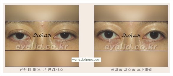 [두한성형외과 경쟁력 눈성형] - [안검하수와 몽고주름에 대한 자주하는 질문과 답변] 관련 이미지 3