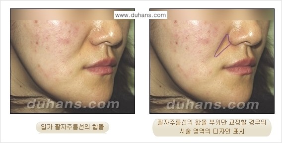 [두한성형외과 경쟁력 미세지방이식] - [귀족수술 입체 미세지방이식] 관련 이미지 7