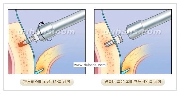 [두한성형외과 경쟁력 주름교정술] - [엔도타인 리프팅 안내 ③] 관련 이미지 10