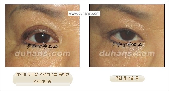 [두한성형외과 성형 FOCUS] - [정상적인 눈매로의 복원 극한재수술 경우 ②] 관련 이미지 4