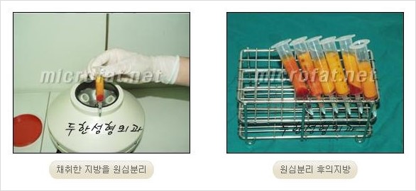 [두한성형외과 경쟁력 코성형 리더] - [자연스럽고 오똑한 콧망울! 코성형 방법]​ 관련 이미지 42