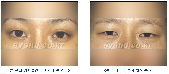 [Double Eyelid Surgery Duhan Plastic Surgery] - [Buried Method, Incision Method, Partial Incision Method] image 9