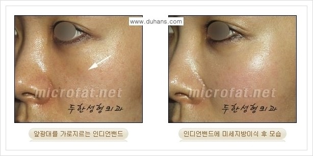 [두한성형외과 경쟁력 미세지방이식] - [귀족수술과 인디언밴드 교정 안내] 관련 이미지 11