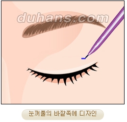 두한성형외과 지방제거 - 눈밑지방, 눈꺼풀지방제거 관련 이미지 3