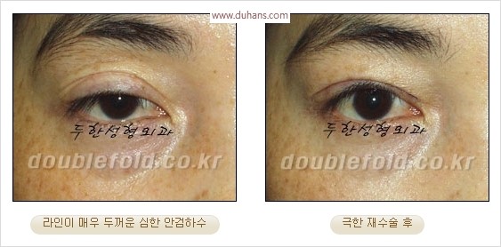 [두한성형외과 경쟁력 눈성형] - [극한 재수술, 함몰된 눈꺼풀 라인교정, 안검하수(졸리운 눈매)] 관련 이미지 15