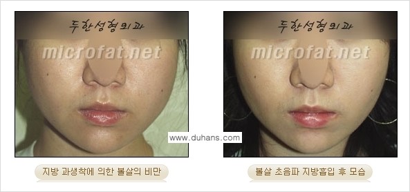 [두한성형외과 경쟁력 지방흡입] - [얼굴, 볼살, 턱살, 턱선의 초음파 지방흡입] 관련 이미지 13
