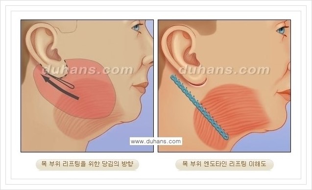 [두한성형외과 경쟁력 주름성형] - [볼처짐 개선, 이마주름 개선을 위한 엔도타인 리프팅 안내] 관련 이미지 8