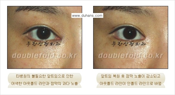 ​[두한성형외과] - [쌍꺼풀 재수술 클리닉의 특성과 자부심] 관련 이미지 4