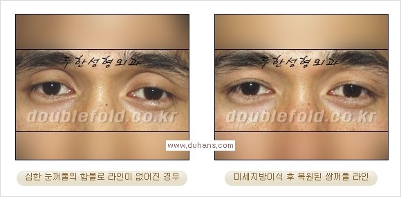 [두한성형외과 경쟁력 쌍꺼풀 재수술, 극한 눈재수술] - [미세지방이식으로 쌍꺼풀 라인의 복원에 관한 질문과 답변] 관련 이미지 6
