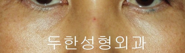 [두한성형외과 다크서클] - [다크서클 콜펫지방이식] 관련 이미지 44